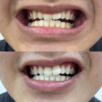 Denticlear Dr.Smile Whitening Pen